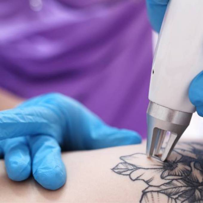 Explaining the Limitations of Laser Tattoo Removal in Dubai