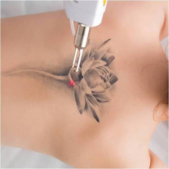 Why Laser Tattoo Removal in Dubai is Better than its alternative methods