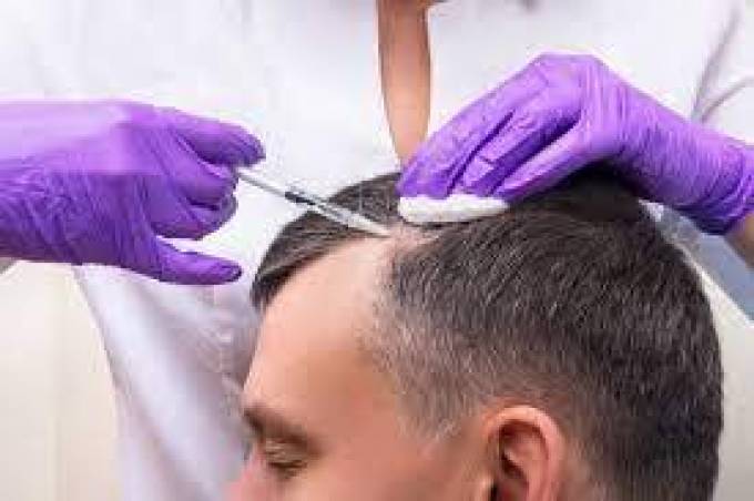 The Role of PRP Hair Therapy in Dubai: Treating Male Pattern Baldness 