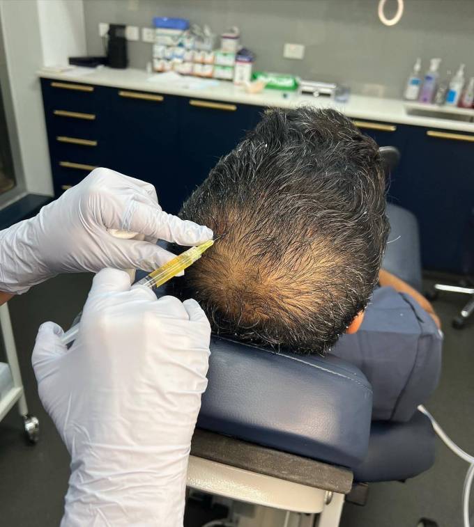 PRP Hair Therapy in Dubai: Addressing the Causes of Hair Loss and Discussing Cost