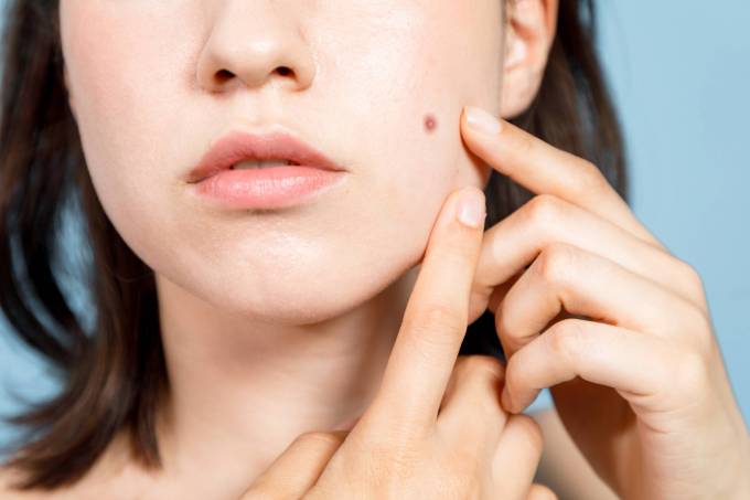 Perfecting Your Profile: Mole Removal in Dubai for the Side of the Face