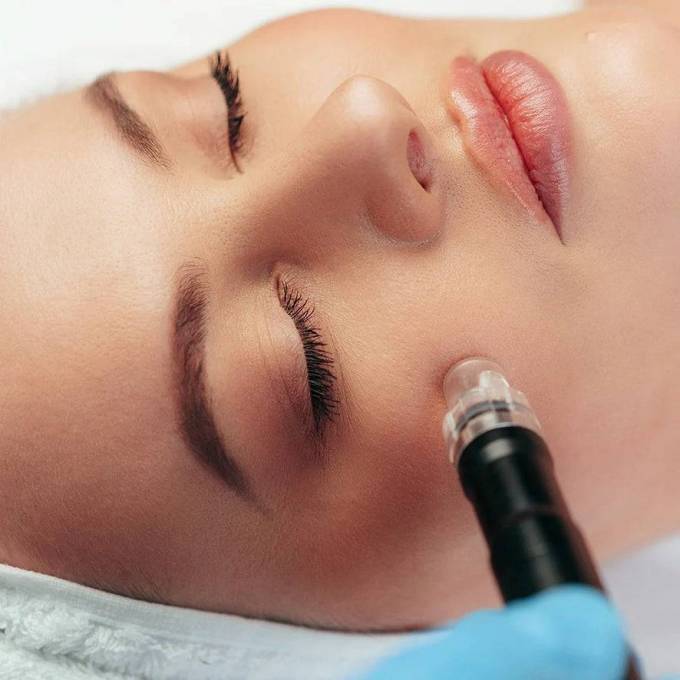 Microneedling Treatment: Your Skin Deserves the Best