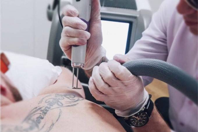 Experience the Benefits of Laser Tattoo Removal