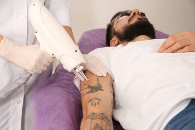 Why Choose Laser Tattoo Removal for Your Ink Issues