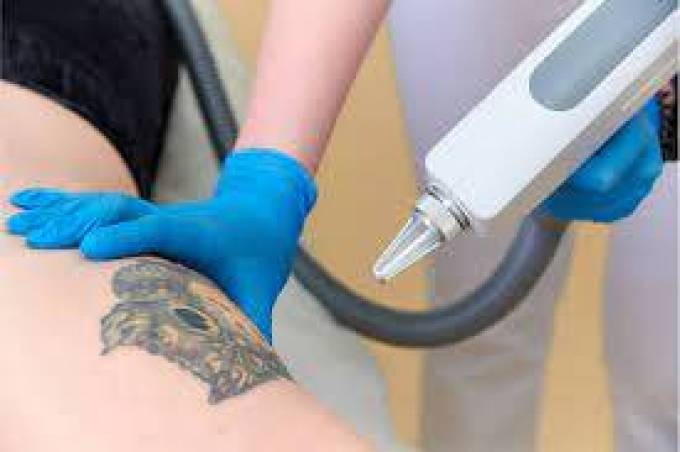 Laser Tattoo Removal: Your Ultimate Guide