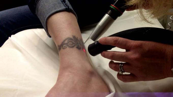 Laser Tattoo Removal: Freedom from Unwanted Tattoos