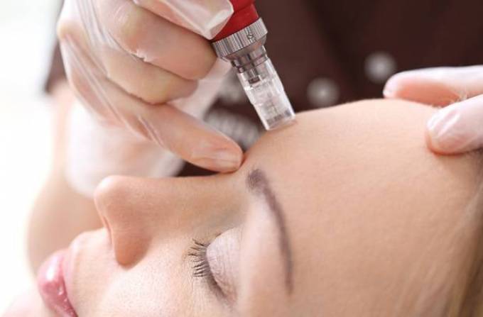 The Ultimate Guide to Microneedling Benefits