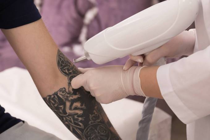 Clear Your Canvas with Laser Tattoo Removal