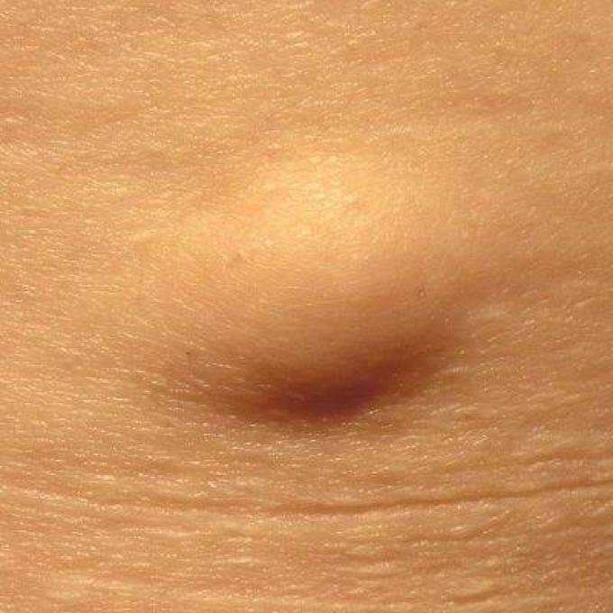 Uncovering the Truth About Lipoma Treatment