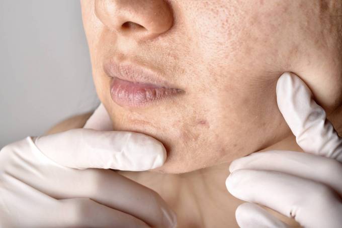 Laser Acne Treatment in Dubai: Clear, Confident You