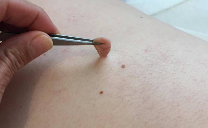 How to Remove Skin Tags on Inner Thigh: Tips for Success