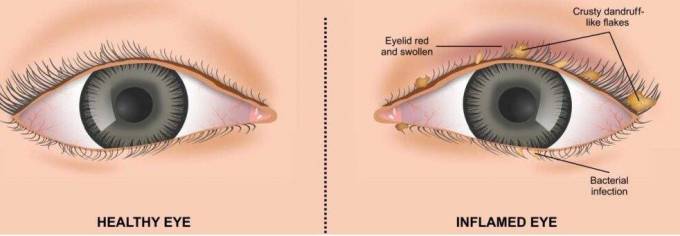 Blepharitis Therapies: Latest Research and Treatment Options