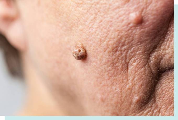 How to Remove Skin Tags on Inner Thigh: Fast Relief