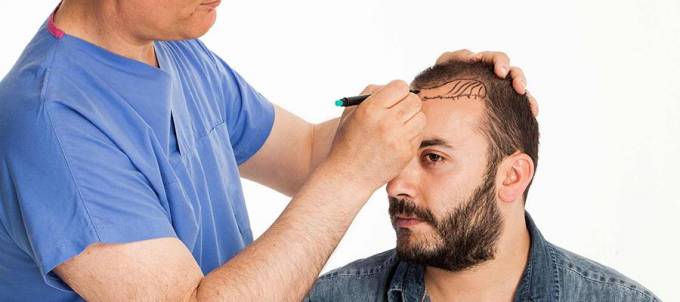 Hair Transplant Cost: Secrets Revealed