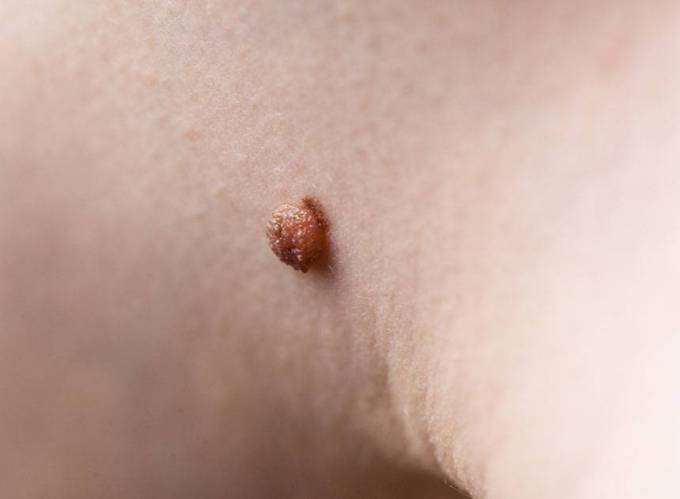 Skin Tags Removal: A Comprehensive Overview