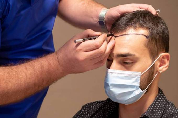 Hair Transplant Cost: Essential Questions to Ask