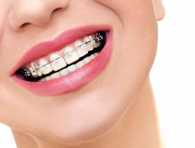 Why Metal Braces Are Worth the Investment in Your Smile