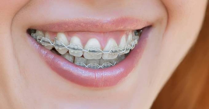 Metal Braces in Dubai: Expert Tips for New Patients