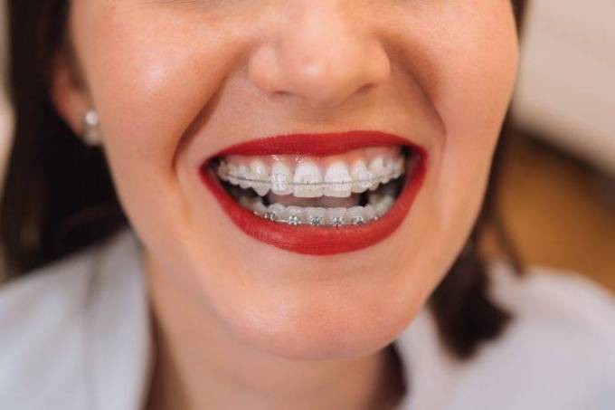 Metal Braces: A Step Towards Your Dream Smile