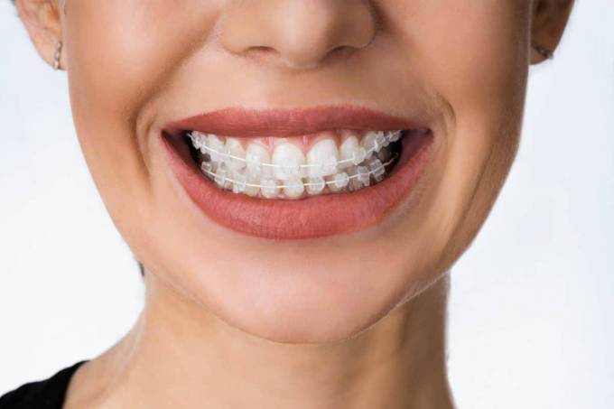 Find Your Perfect Fit with Metal Braces