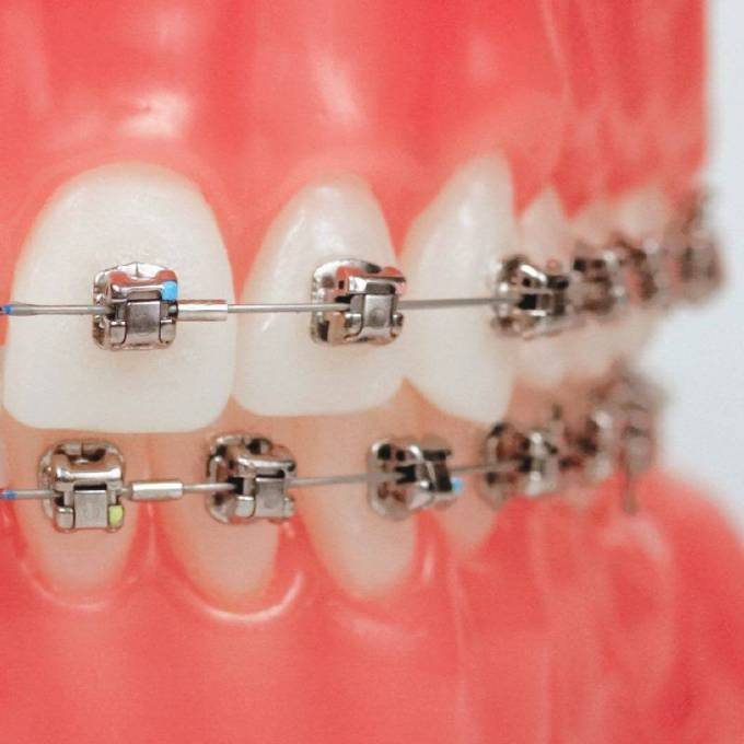 Why Metal Braces Remain a Popular Choice Today