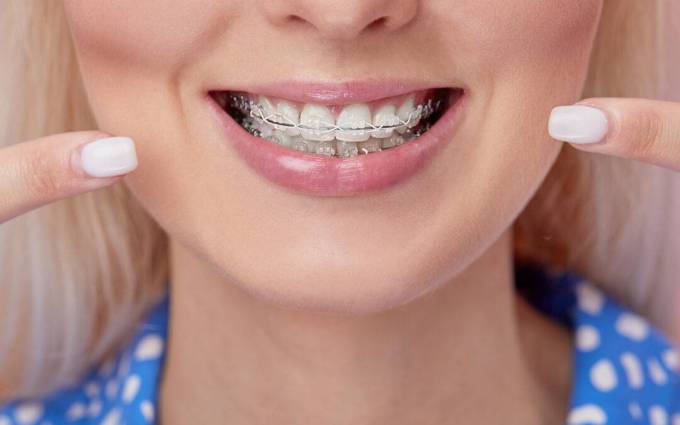 Find Your Perfect Fit with Metal Braces in Dubai