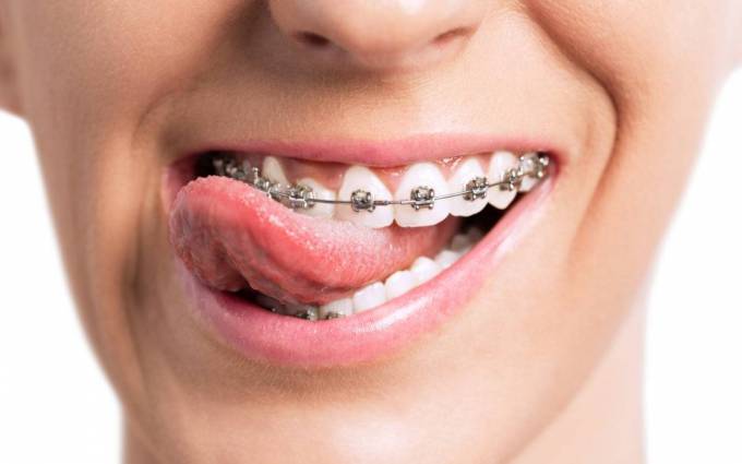 Elevate Your Smile with Metal Braces in Dubai