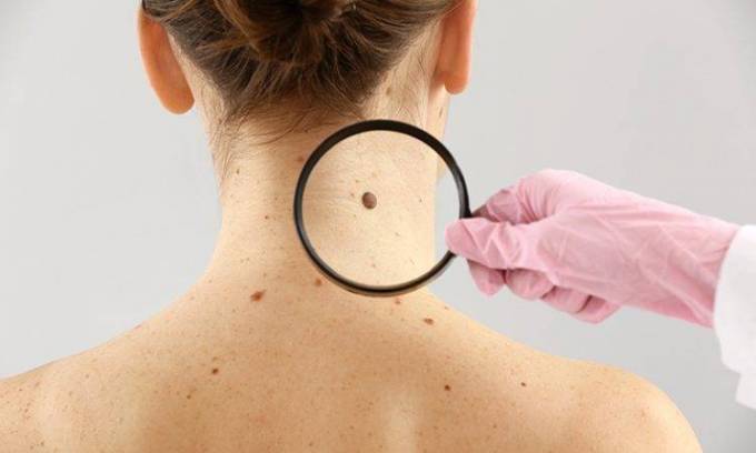 Skin Tag Removal in Dubai: Restore Your Skin’s Beauty