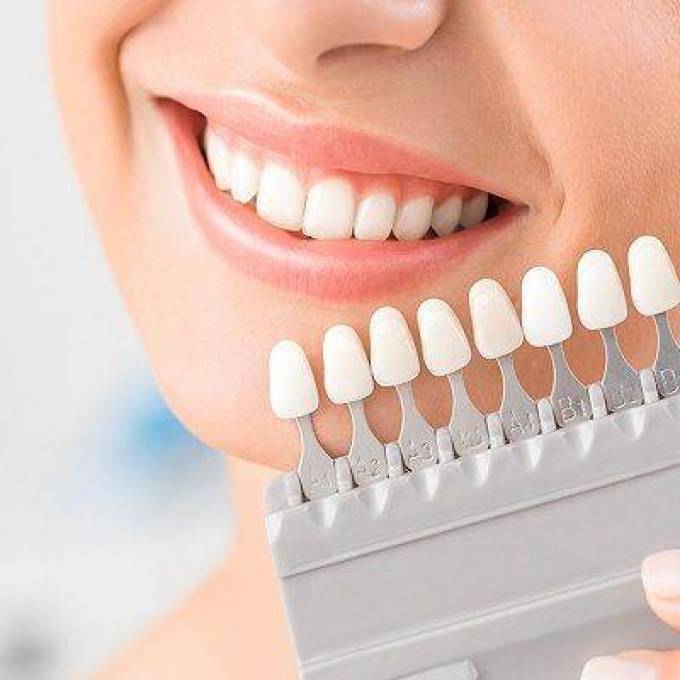 Dental Veneers: A Smile That Speaks Volumes