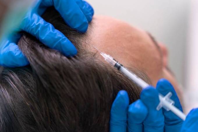 FUE Hair Transplants: A Life-Changing Experience