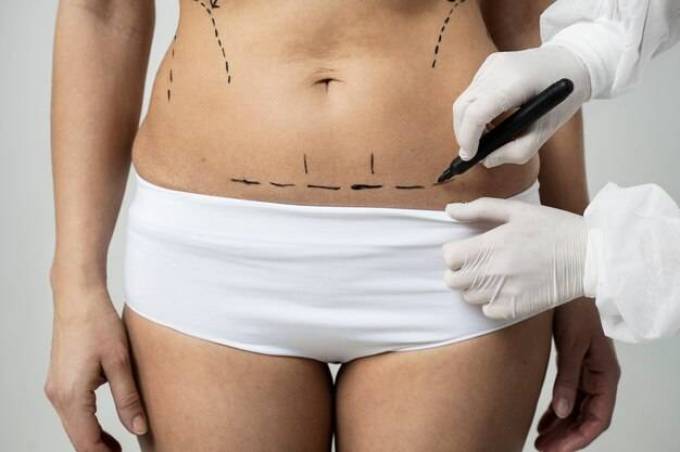 Everything You Should Know About Laser Stretch Marks Removal: The Ultimate Guide