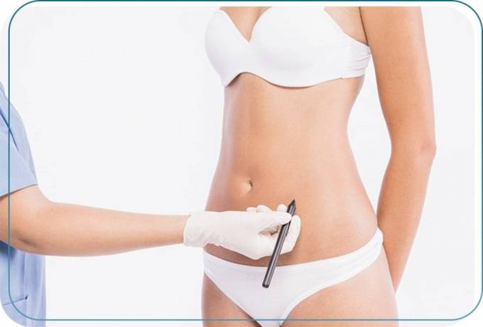 Traditional Liposuction: The Classic Technique