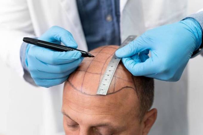 Reclaim Your Youth with FUE Hair Transplants