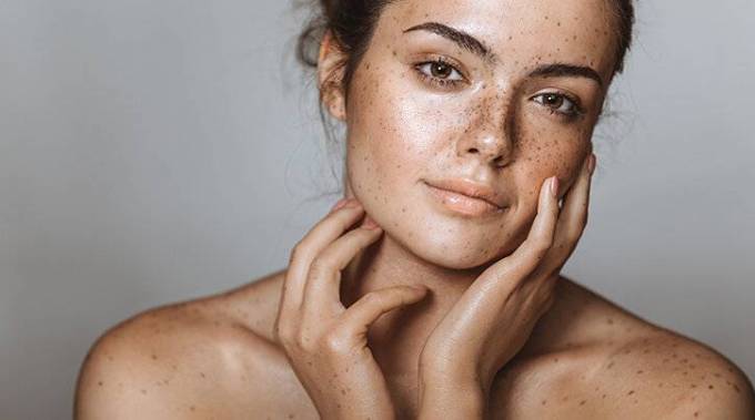 Does Melasma Go Away? How to Treat Melasma?