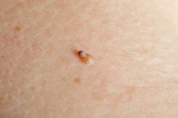 What Age Is Best for Skin Tag Removal Treatment?