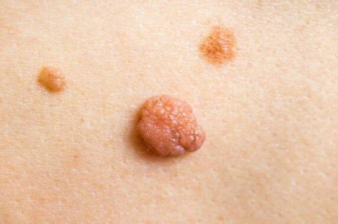 What Aftercare Is Needed Post Skin Tag Removal?