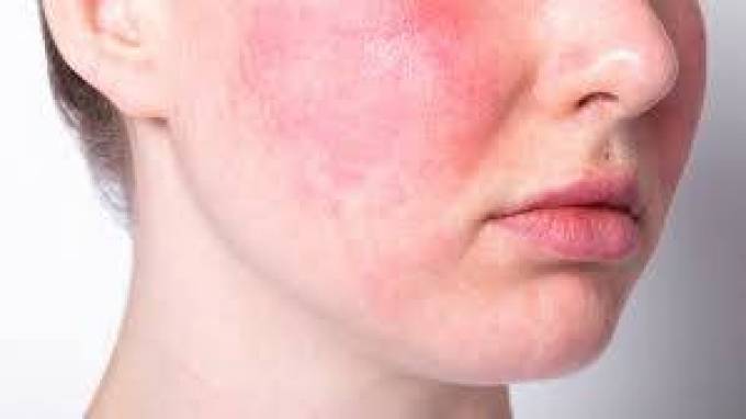 What Are the Risks Associated with Rosacea Treatment?