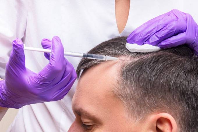 How Do You Prepare for PRP Hair Treatment?