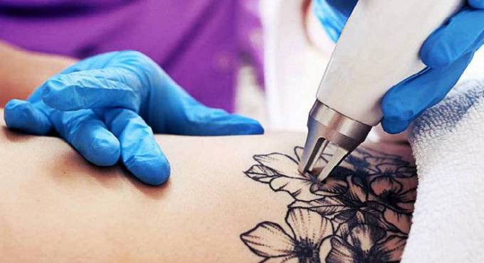 Is Laser Tattoo Removal Safe for All Skin Types?