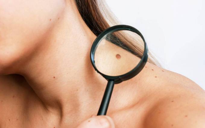 What is a healthy mole appearance?