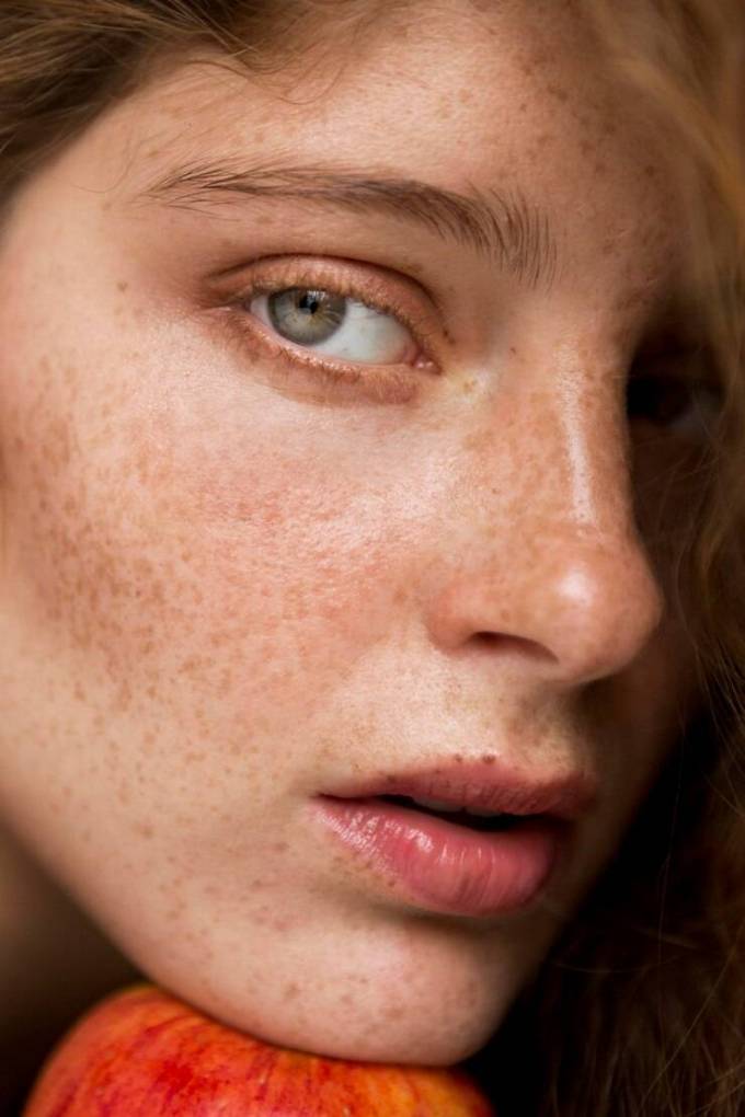 What Melasma Treatment Options Are Safe for All Ages?