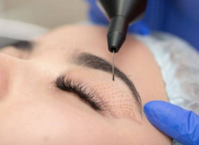 Can Plasma Pen Lift Droopy Eyelids?