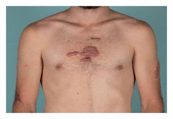 How Does Laser Scar Removal Work for Chest Scars?