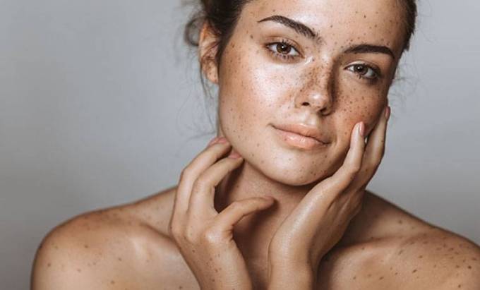 How Does Laser Therapy Reduce Melasma Marks?