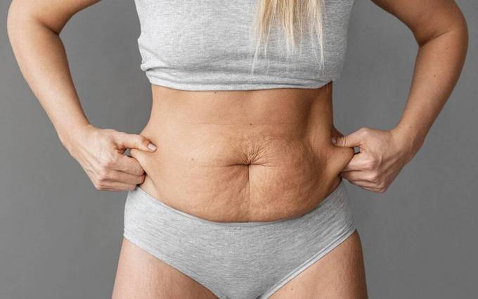 Which treatment is best for stretch mark removal around the belly button area?