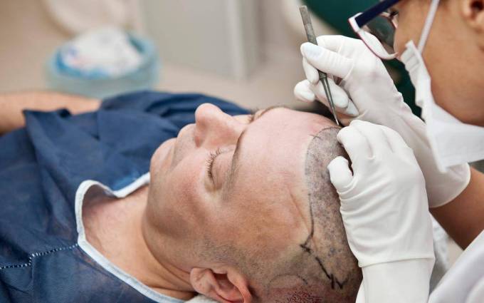 Can Hair Transplant Be Reversed?